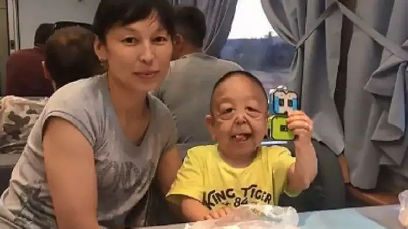 鼻酸!先天性罕見疾病 6歲男童面容衰老如80歲 - COCO大馬