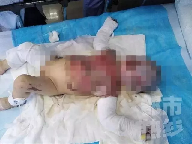 電動車撞翻早餐攤油鍋 1歲半男娃被熱油從頭澆下