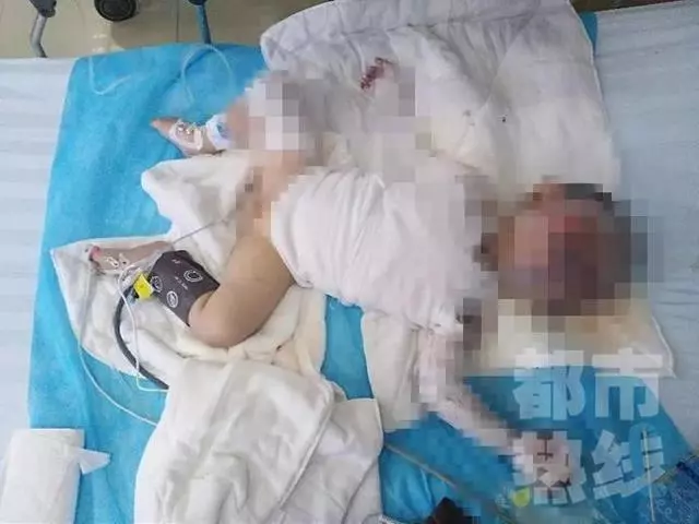 電動車撞翻早餐攤油鍋 1歲半男娃被熱油從頭澆下