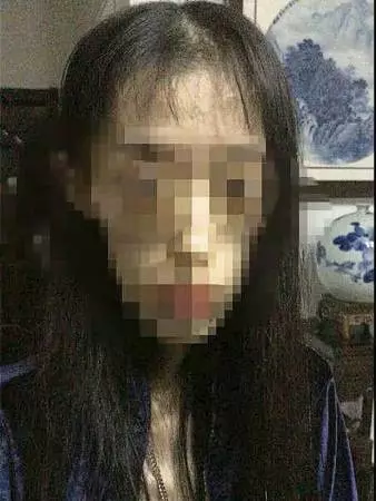 少女瘋狂減肥剩25公斤 腦組織退化如60歲老人 -