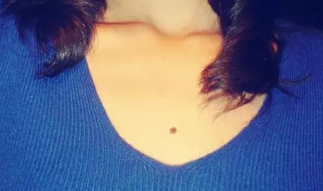 女人身上這四顆痣打死不能點掉,否則好運變黴運!