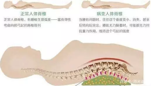 腰椎間盤患者,睡覺有訣竅!——達到「臥如弓」最好