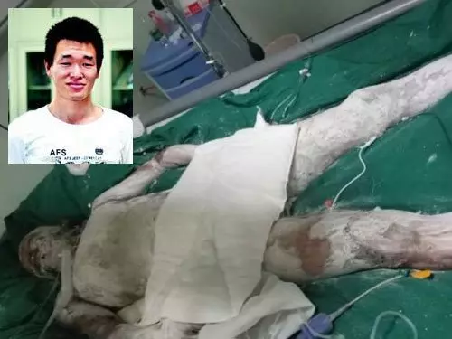 26歲青年釣魚觸電,全身燒傷70%,求父母,讓他安樂死 -