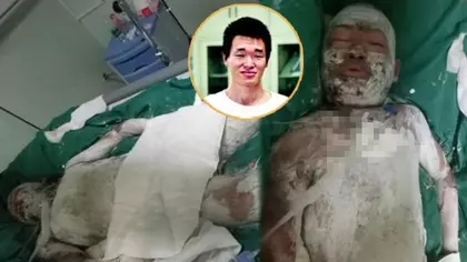 26歲青年釣魚觸電,全身燒傷70%,求父母,讓他安樂死 -