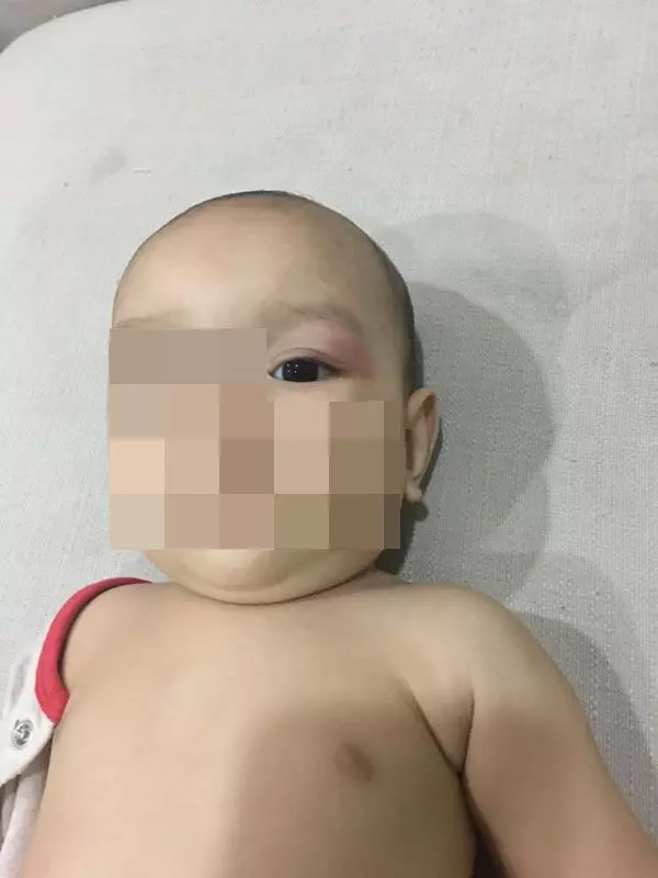 【大馬新聞】又是保母虐嬰! 男嬰眼紅腫 背瘀青