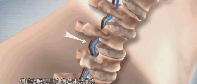 頸椎酸疼難忍,一個礦泉水瓶幫你解救頸椎!