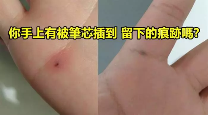 網友在網上求助「筆芯插到手裡該怎麼辦」,結果鄉民們都紛紛「曬出手上小黑點」!