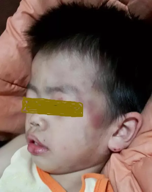 保姆虐打5歲小男孩導致全身傷痕累累 惡毒保姆否認打人