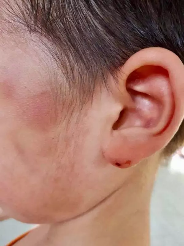 保姆虐打5歲小男孩導致全身傷痕累累 惡毒保姆否認打人