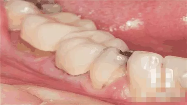 經常咬到舌頭的人要當心:或預示5種病!第1種最容易被忽視