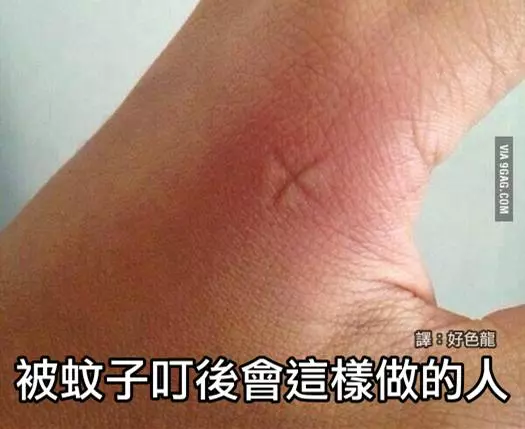 阿嫲祖傳秘方? 被蚊子咬後,止癢最效的方法!第5種方法,你一定從小到大都try過!