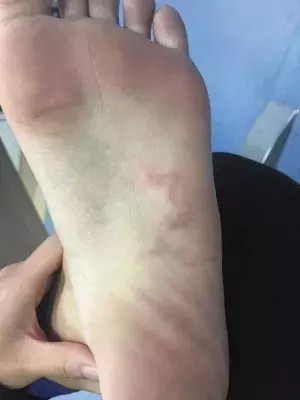 沙灘赤腳要當心!新婚夫妻泰國游,腳底遭寄生蟲鑽入,治療方法很恐怖~