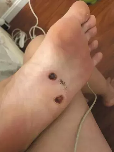 沙灘赤腳要當心!新婚夫妻泰國游,腳底遭寄生蟲鑽入,治療方法很恐怖~