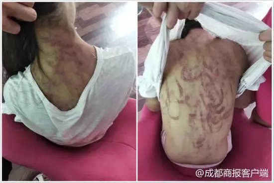 12歲女童被繼母虐打全身瘀青 父親:女兒叛逆難管教