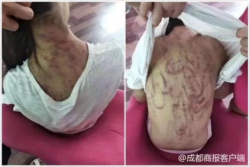 遭繼母毒打滿身血痕 女童:習慣了
