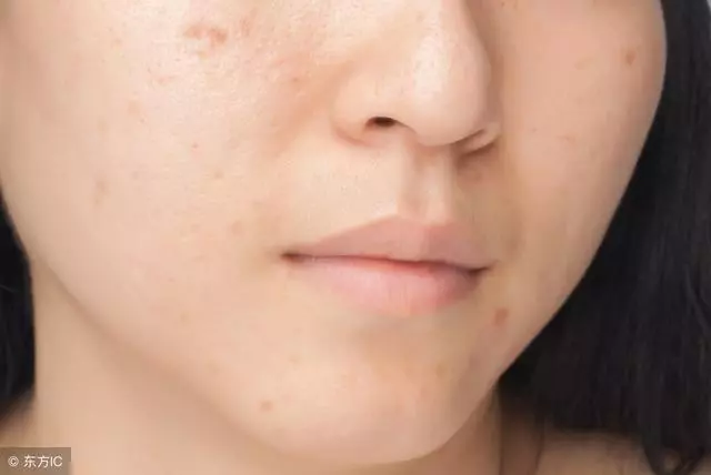 人體自帶2個「除痘穴」,輕輕一按,治好青春痘!