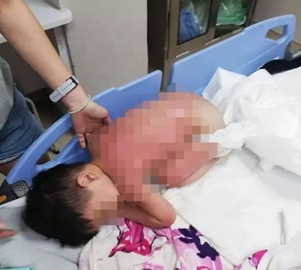 鋼化玻璃液化石油氣爐爆炸 2歲男童慘遭燙傷