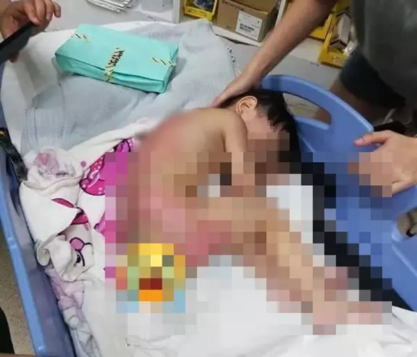 鋼化玻璃液化石油氣爐爆炸 2歲男童慘遭燙傷