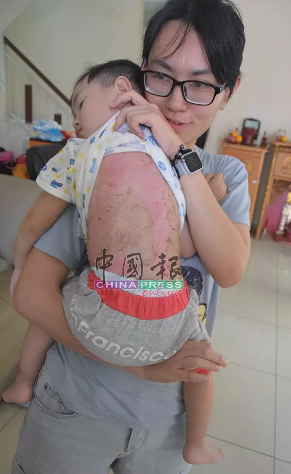 鋼化玻璃液化石油氣爐爆炸 2歲男童慘遭燙傷
