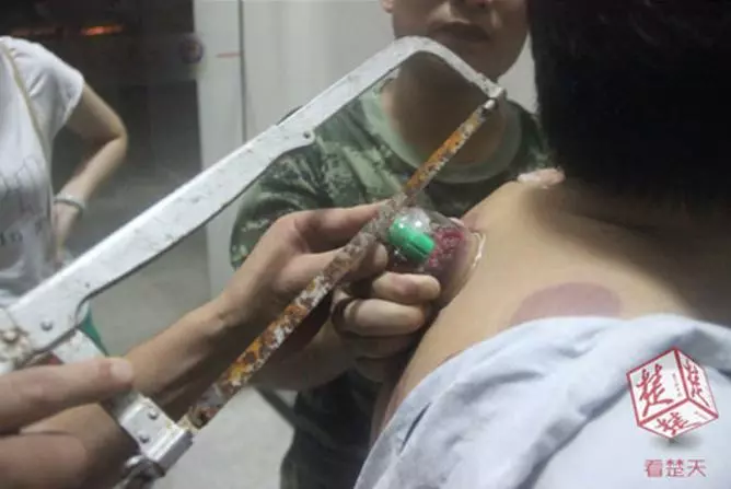 他自己「在家拔罐」卻卡死拔不下來,消防隊到場「用鋸子破壞」才發現來不及了!....