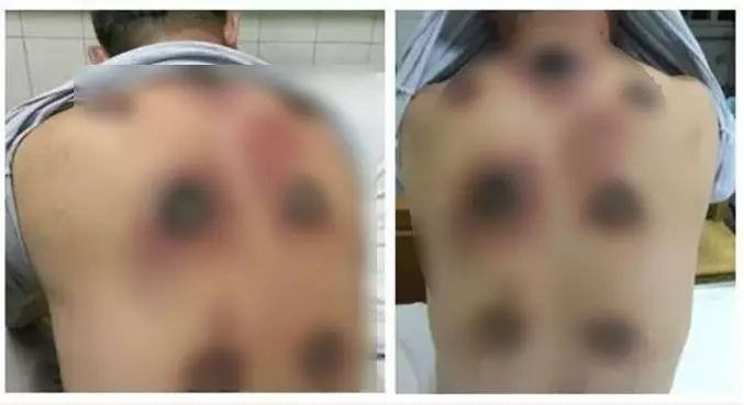 他自己「在家拔罐」卻卡死拔不下來,消防隊到場「用鋸子破壞」才發現來不及了!....