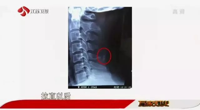 幾個小動作,輕鬆緩解頸椎病!不花一分錢,在家就能做