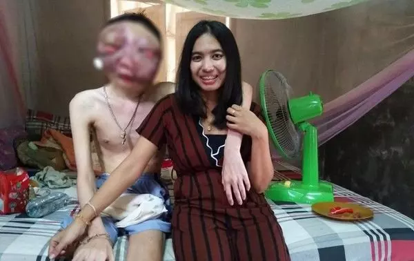 男子眼癌雙眼爆出毀容 貌美女友陪伴至病逝