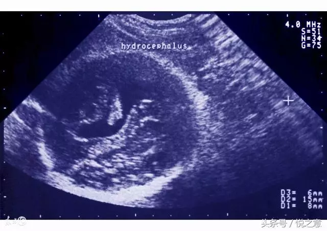 35歲孕婦產檢時發現胎兒有問題,堅持生下來後,全家笑了她哭了