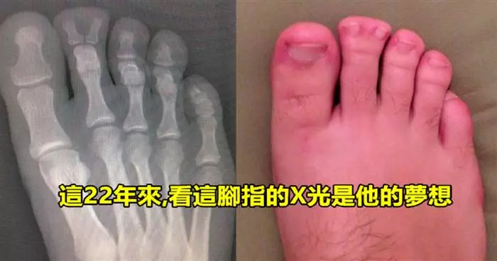20張「難得一見的X光片!」肚子有「異物」的片是長怎樣的呢?