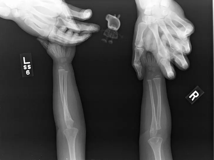 20張「難得一見的X光片!」肚子有「異物」的片是長怎樣的呢?