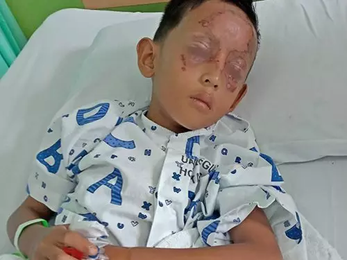 8歲男童點燃自製爆竹,結果險些失明!