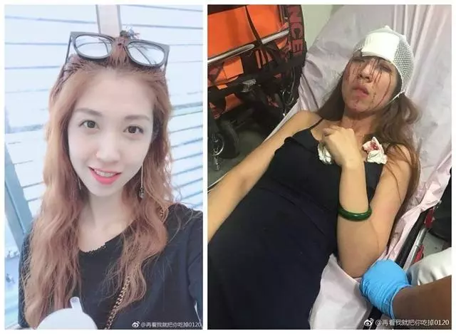 滴滴回應25歲女模坐快車被毀容:家屬要求賠償20萬,涉事司機封號
