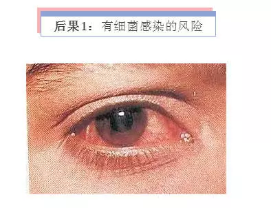 揉眼的三種嚴重後果,你要重視!