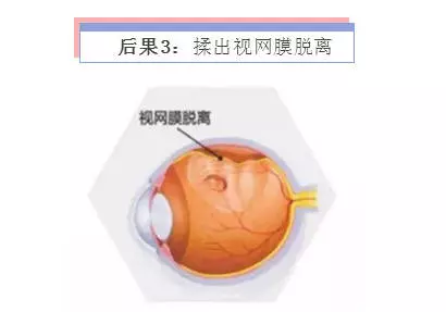 揉眼的三種嚴重後果,你要重視!