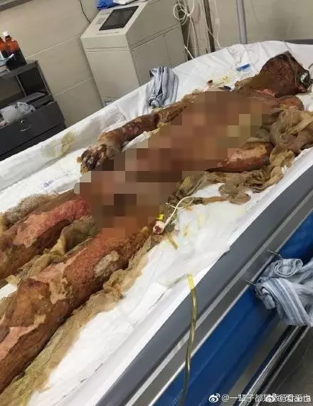 工作意外灼傷成人干 公司竟稱「開水燙的」這種人渣公司真是太過份了 -