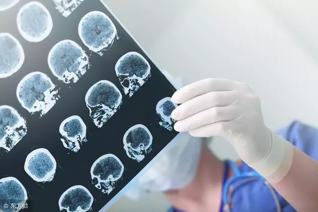 腦中風也有前兆,專家告訴你腦中風的8點前兆