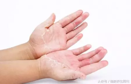 濕疹惹人煩,3個食譜要收藏,1個簡單治療方法,解決多年濕疹