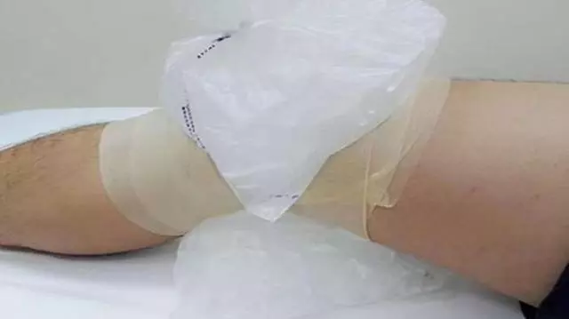 身上無緣無故出現淤青?可能和這8個原因有關!3個方法快速消除