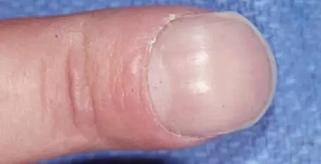 很多人都沒發現!!「手指」突然出現這種 小水泡…竟是大病前兆!!千萬要小心了…