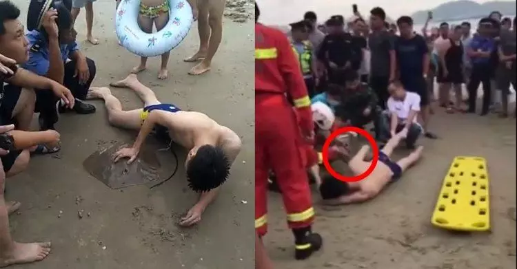 遭魟魚毒刺插小弟弟!醫護人員當機立斷「當場切掉」喀擦一聲... 網:看著都疼 (影)