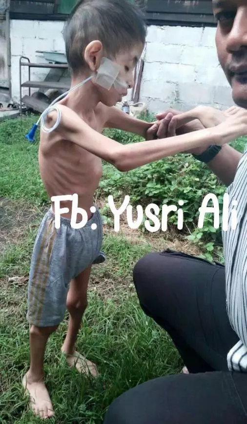 【請救救他吧!】15歲的Afiq患上罕見疾病,每天需靠藥物生存,體重只剩下9kg!