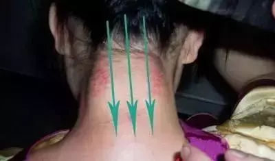 全身各處的具體刮痧方法,請牢記!