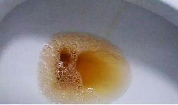 肝不好的人,上廁所會有這4種表現,占了一個,都要抓緊養肝了!