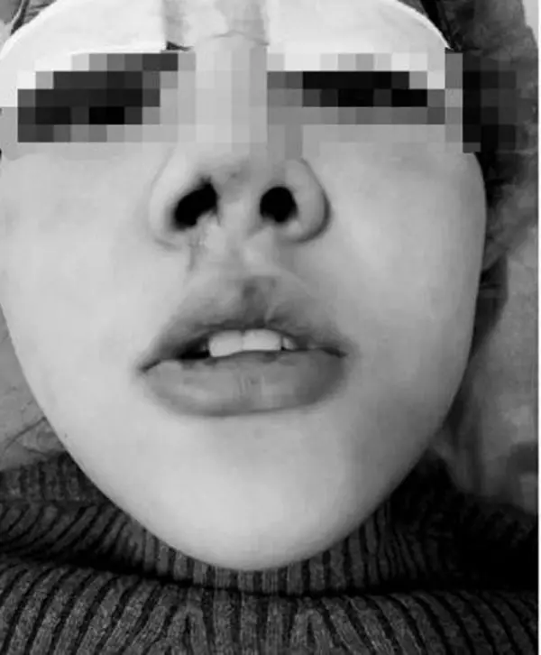 河南女大生整形失敗 鼻孔一大一小