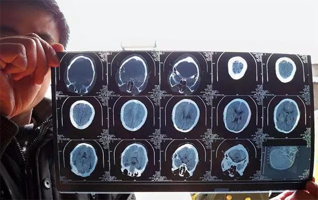 大腦血管好不好,「抬雙臂」可能會知道,不論男女,不妨自測一下