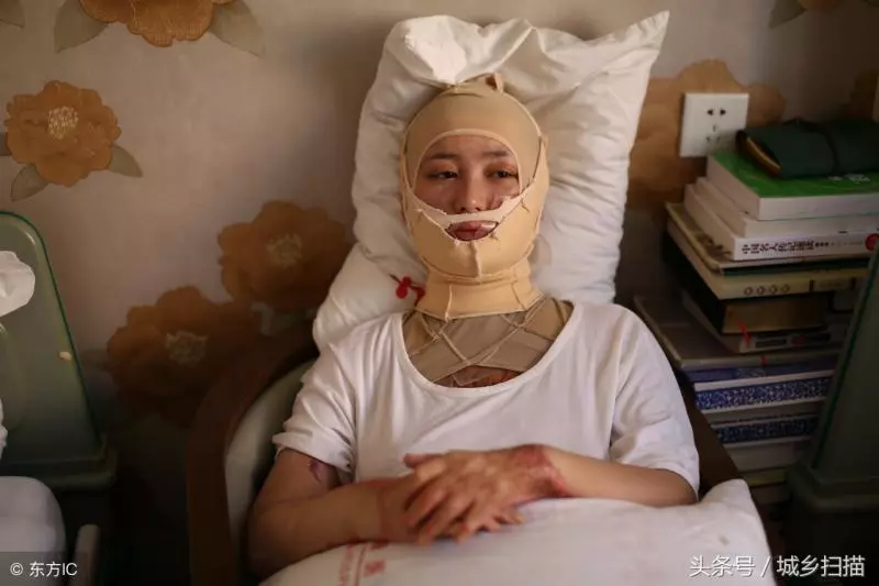 官二代」求愛不成,對17歲少女殘忍毀容面目全非,燒掉一隻耳朵