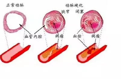 老中醫：血管堵塞時你沒有感覺，到了晚期你才知道。