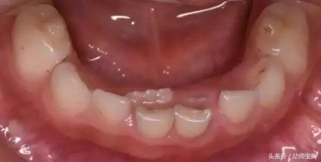 10個孩子裡面5個長雙排牙,醫生感嘆:都是家長喂出來的