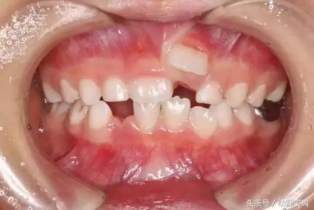 10個孩子裡面5個長雙排牙,醫生感嘆:都是家長喂出來的