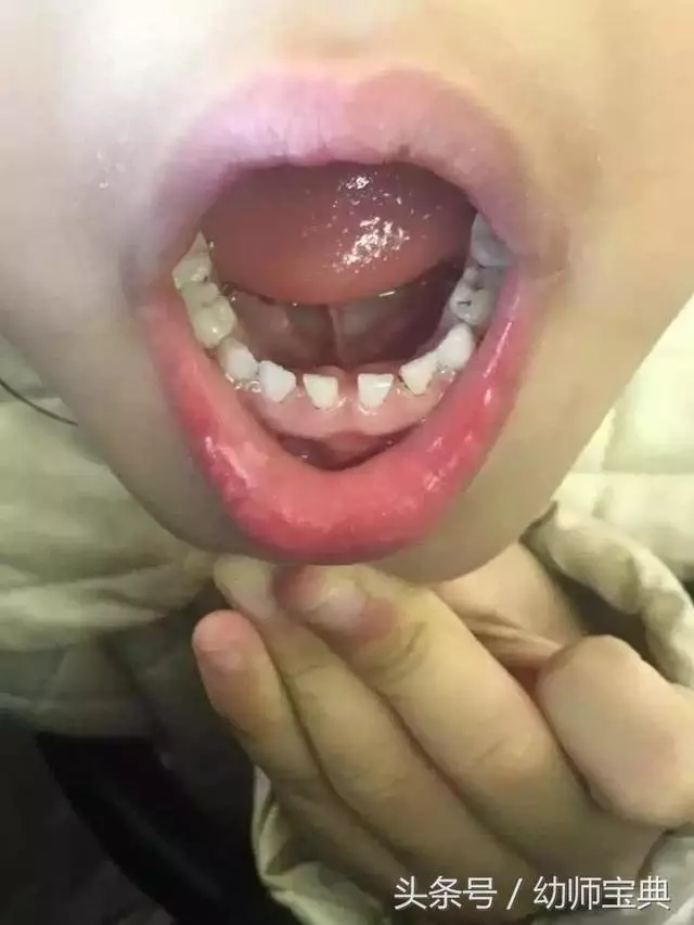 10個孩子裡面5個長雙排牙,醫生感嘆:都是家長喂出來的